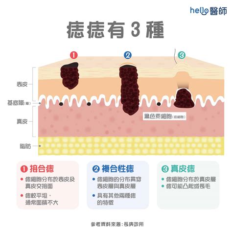 外痣成因